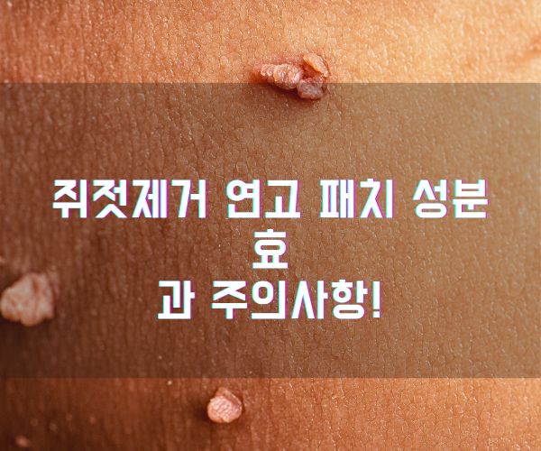 쥐젓제거 연고 패치 성분 효과 주의사항!