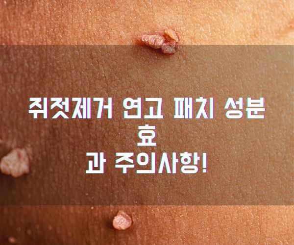 쥐젖제거크림 성분 효과 주의사항! (1)