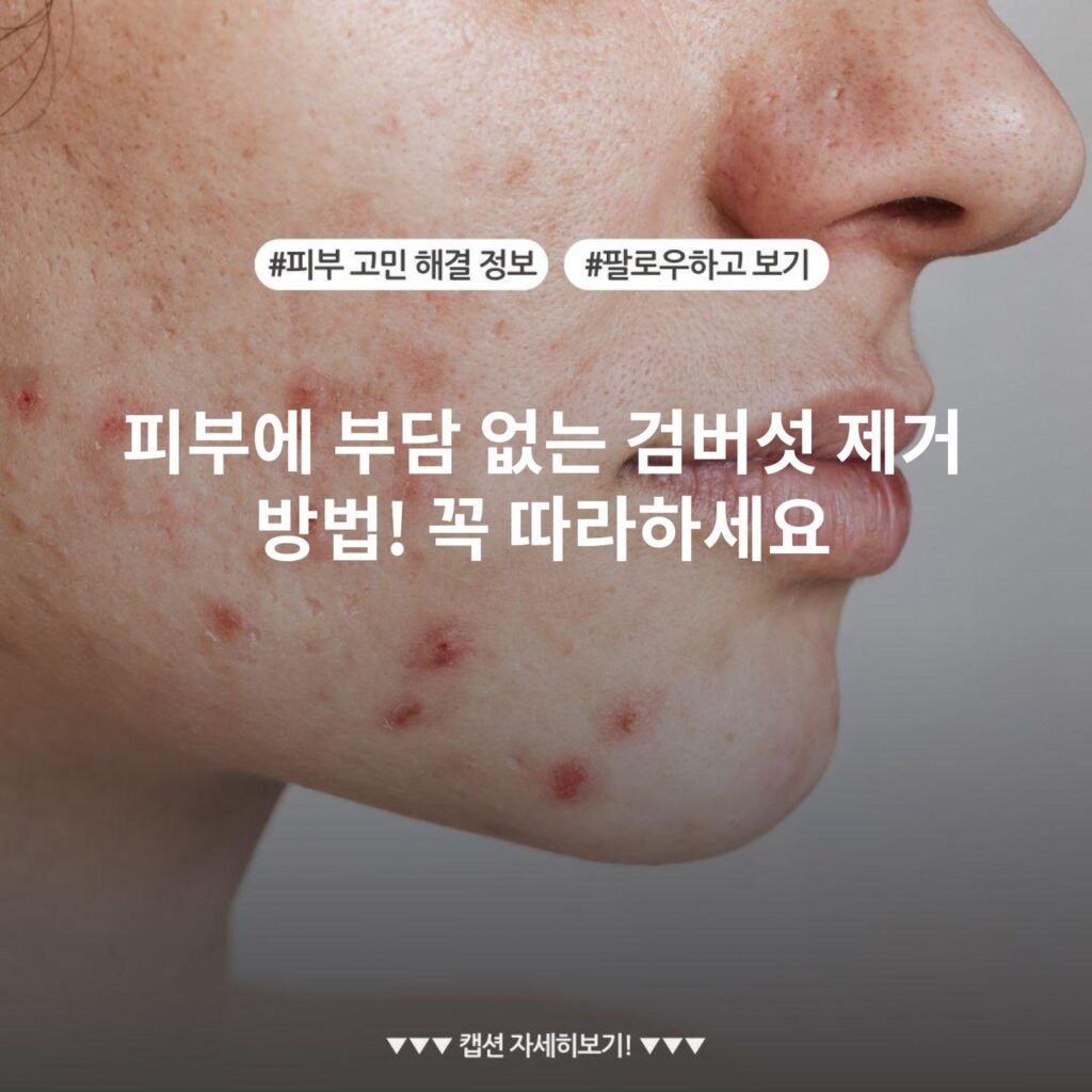 피부에 부담 없는 검버섯 제거 방법! 꼭 따라하세요