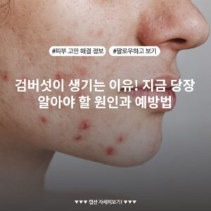 검버섯이 생기는 이유! 지금 당장 알아야 할 원인과 예방법