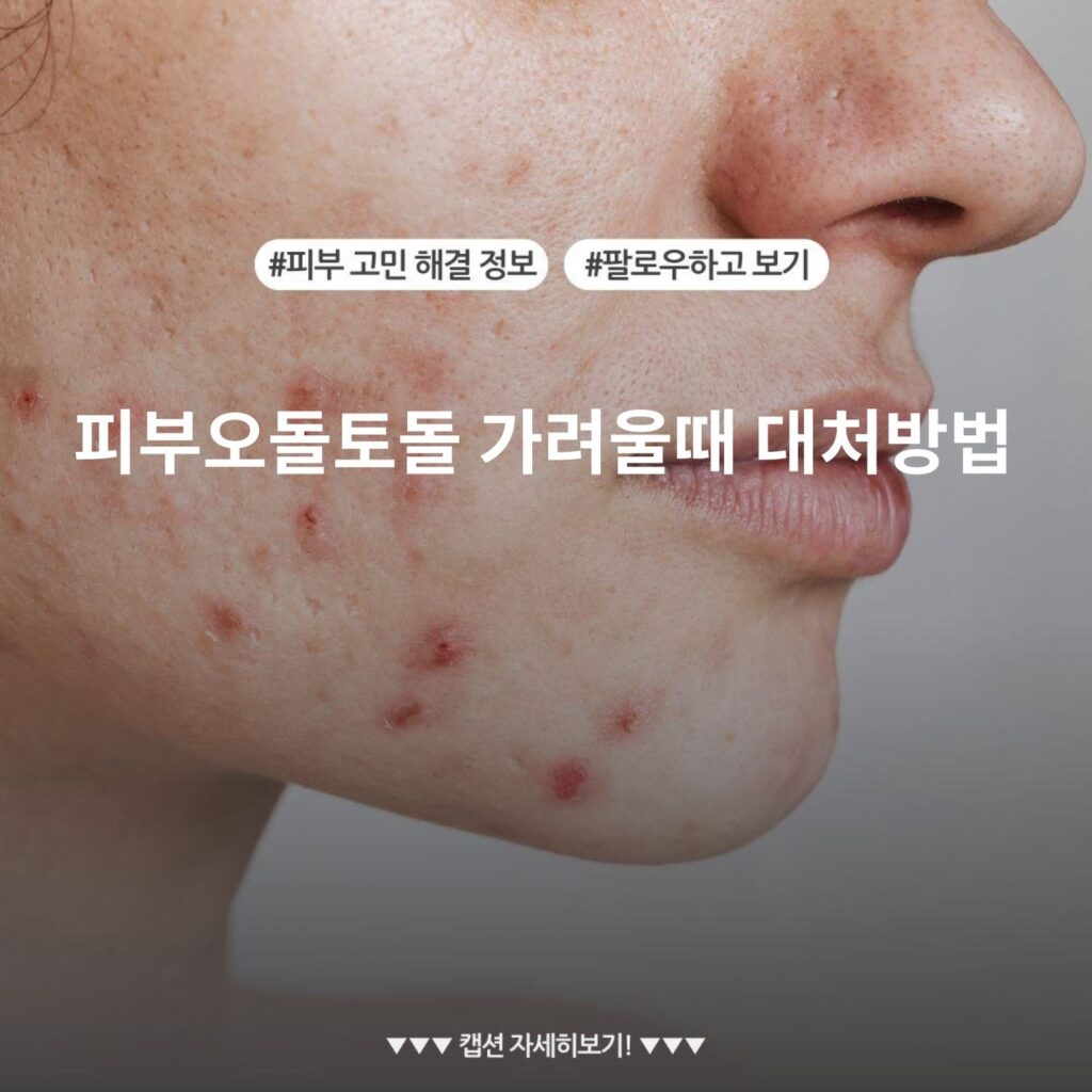 피부오돌토돌 가려울때 대처방법