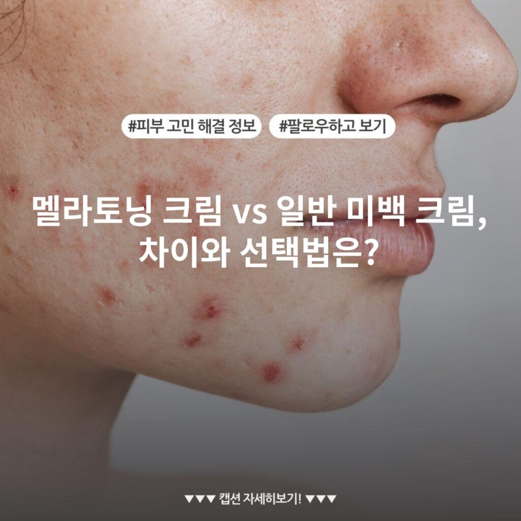 멜라토닝 크림 vs 일반 미백 크림, 차이와 선택법은?