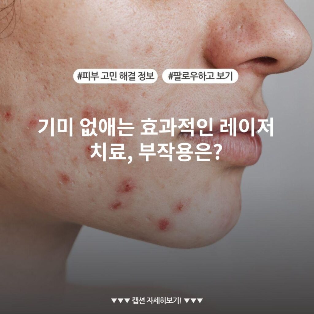 기미 없애는 효과적인 레이저 치료, 부작용은?