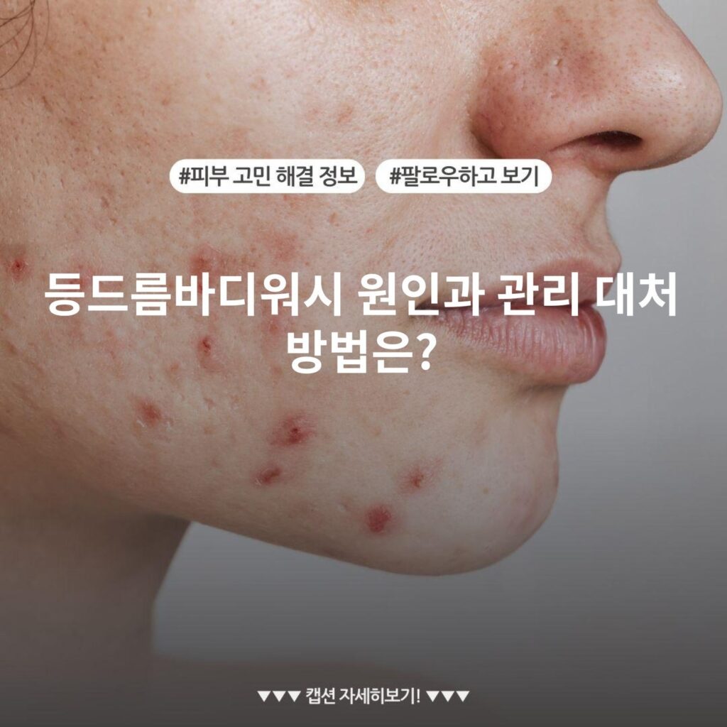 등드름바디워시 원인과 관리 대처 방법은?