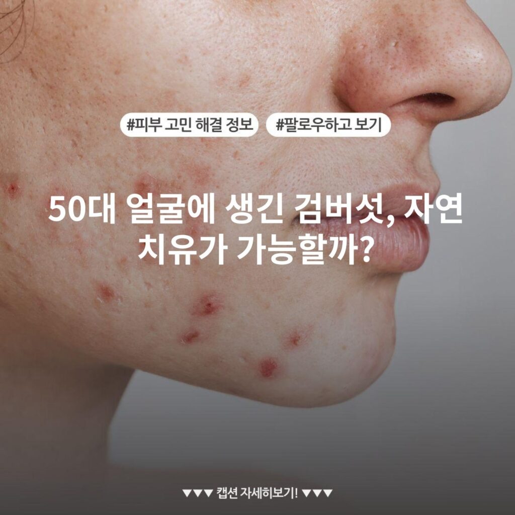 50대 얼굴에 생긴 검버섯, 자연 치유가 가능할까?