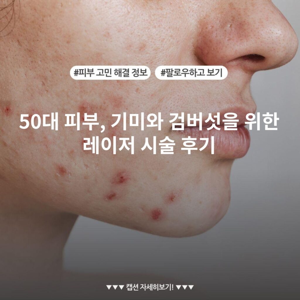 50대 피부, 기미와 검버섯을 위한 레이저 시술 후기