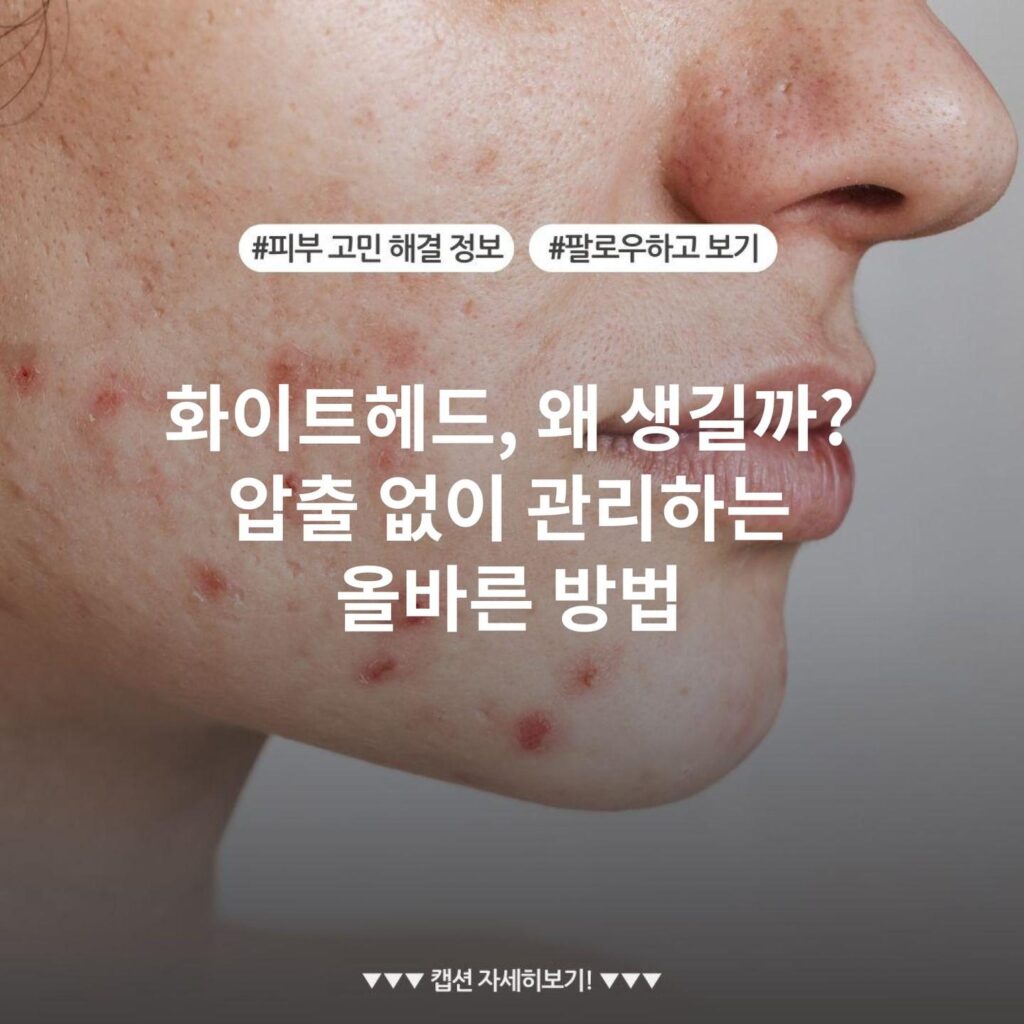 화이트헤드, 왜 생길까? 압출 없이 관리하는 올바른 방법