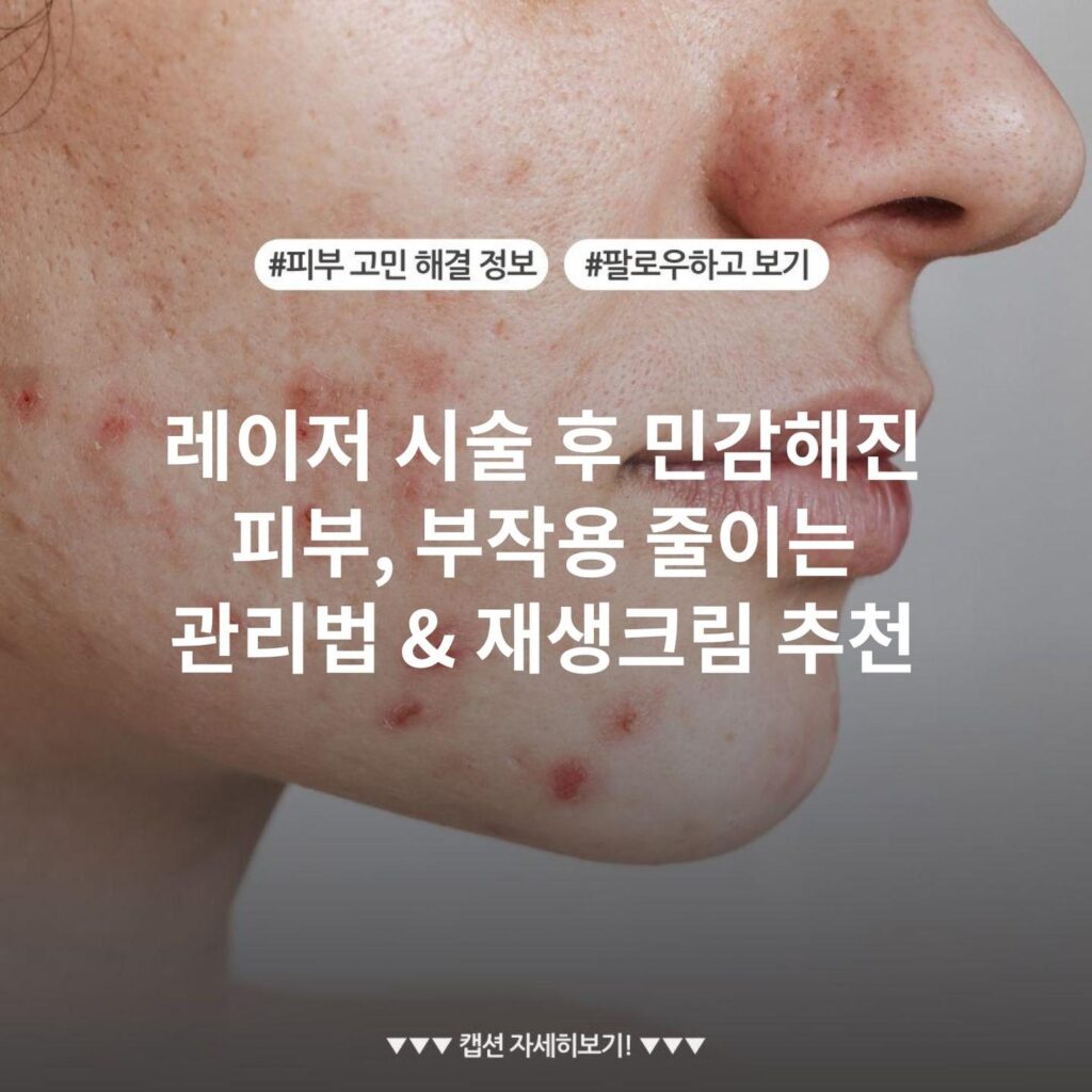 레이저 시술 후 민감해진 피부, 부작용 줄이는 관리법 & 재생크림 추천