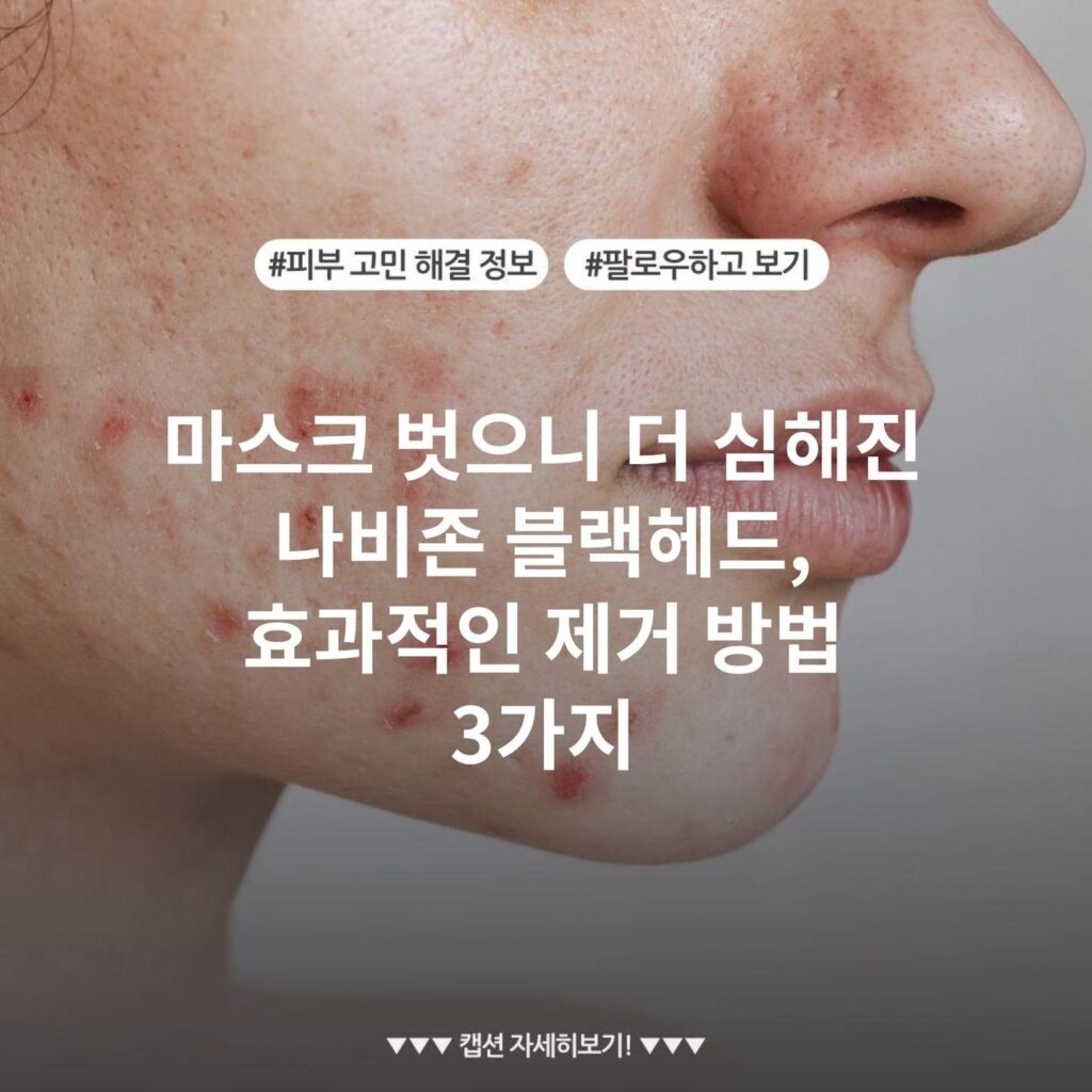 마스크 벗으니 더 심해진 나비존 블랙헤드, 효과적인 제거 방법 3가지