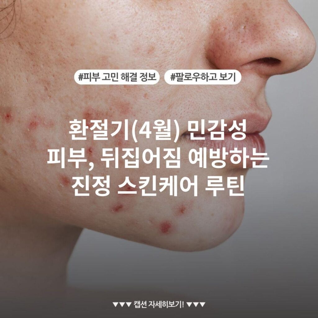 환절기(4월) 민감성 피부, 뒤집어짐 예방하는 진정 스킨케어 루틴
