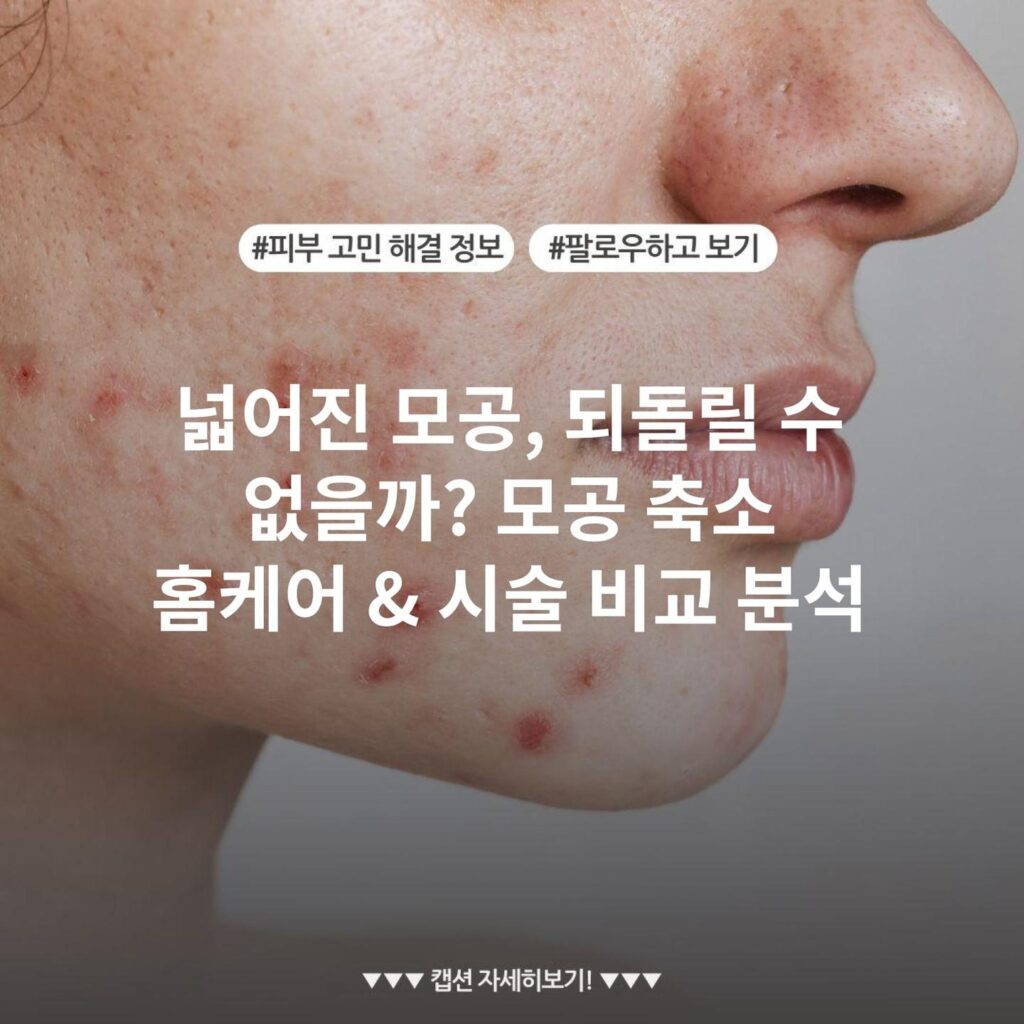 넓어진 모공, 되돌릴 수 없을까? 모공 축소 홈케어 & 시술 비교 분석