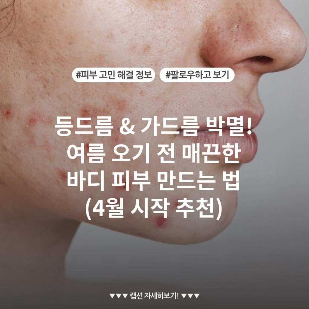 등드름 & 가드름 박멸! 여름 오기 전 매끈한 바디 피부 만드는 법 (4월 시작 추천)