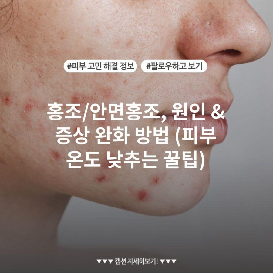 홍조/안면홍조, 원인 & 증상 완화 방법 (피부 온도 낮추는 꿀팁)