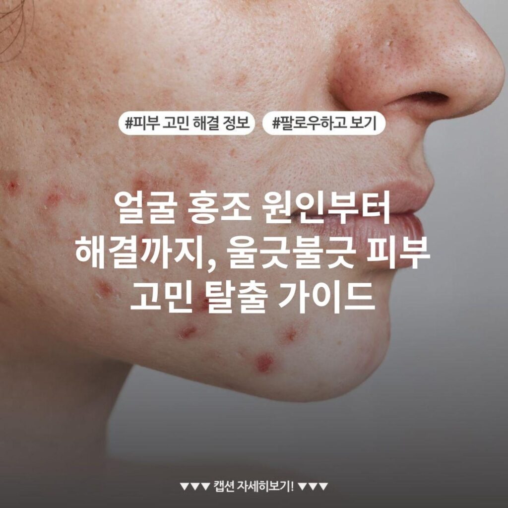 얼굴 홍조 원인부터 해결까지, 울긋불긋 피부 고민 탈출 가이드