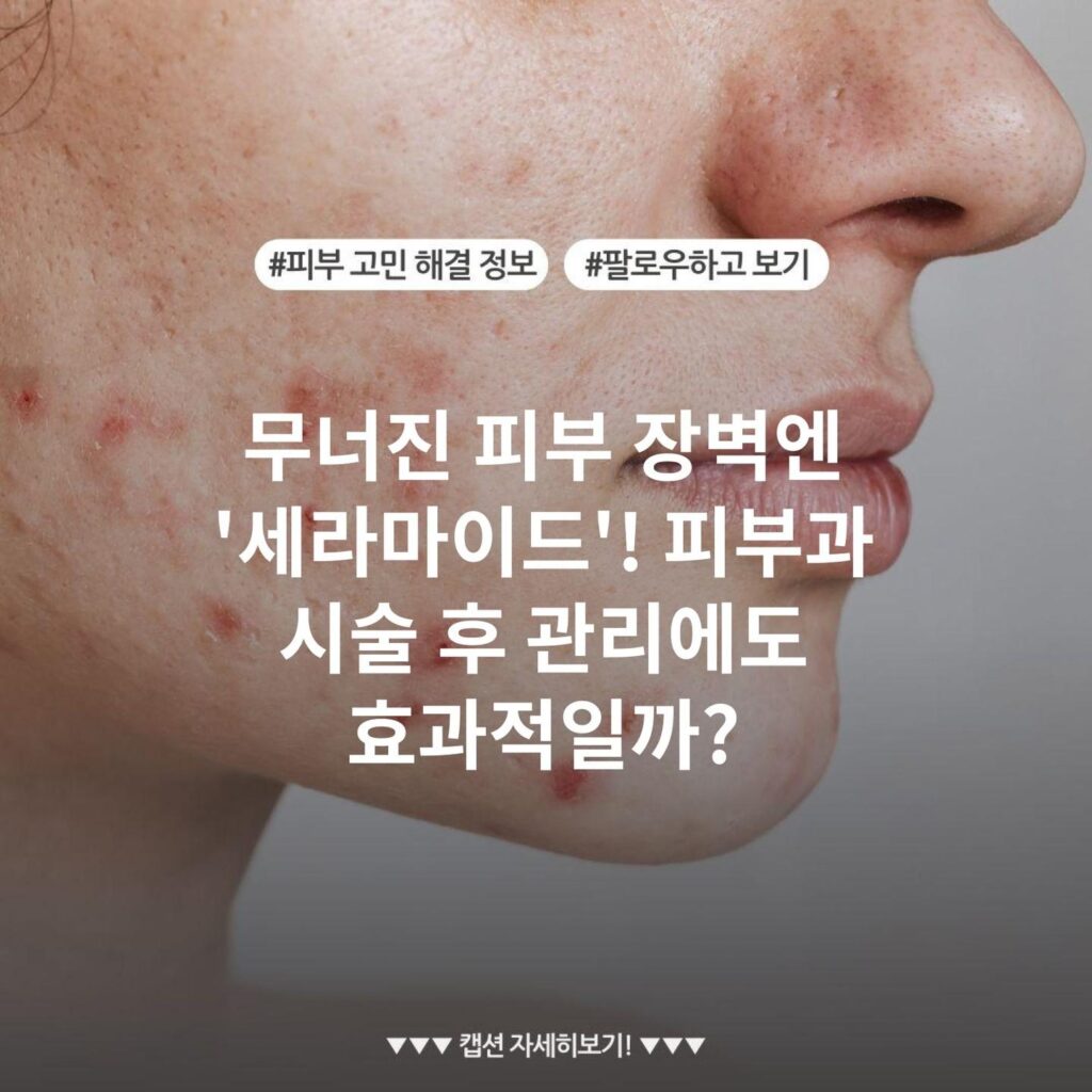 무너진 피부 장벽엔 '세라마이드'! 피부과 시술 후 관리에도 효과적일까?