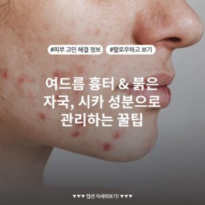 여드름 흉터 & 붉은 자국, 시카 성분으로 관리하는 꿀팁