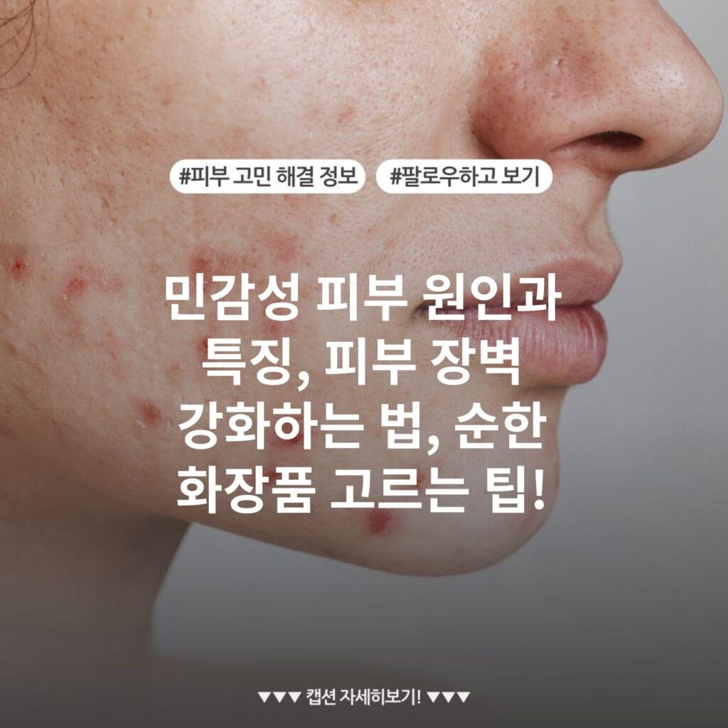 민감성 피부 원인과 특징, 피부 장벽 강화하는 법, 순한 화장품 고르는 팁!