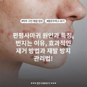 편평사마귀 원인과 특징, 번지는 이유, 효과적인 제거 방법과 재발 방지 관리법!