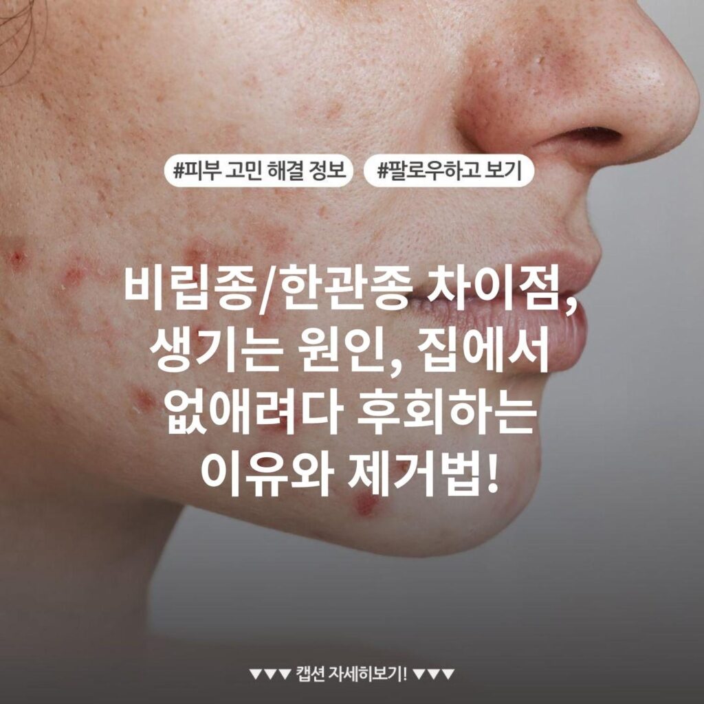 비립종/한관종 차이점, 생기는 원인, 집에서 없애려다 후회하는 이유와 제거법!