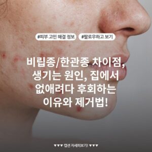 비립종/한관종 차이점, 생기는 원인, 집에서 없애려다 후회하는 이유와 제거법!