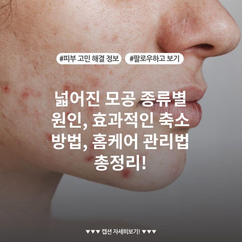 넓어진 모공 종류별 원인, 효과적인 축소 방법, 홈케어 관리법 총정리!
