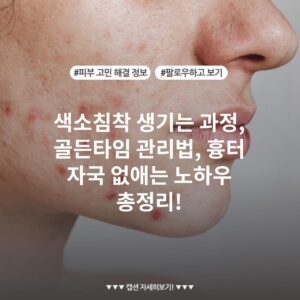 색소침착 생기는 과정, 골든타임 관리법, 흉터 자국 없애는 노하우 총정리!