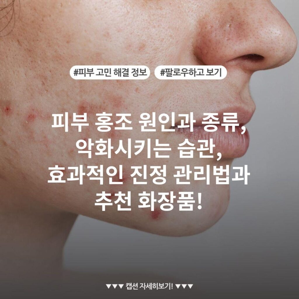 피부 홍조 원인과 종류, 악화시키는 습관, 효과적인 진정 관리법과 추천 화장품!