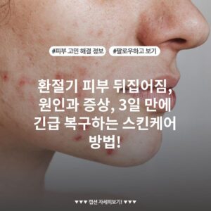 환절기 피부 뒤집어짐, 원인과 증상, 3일 만에 긴급 복구하는 스킨케어 방법!