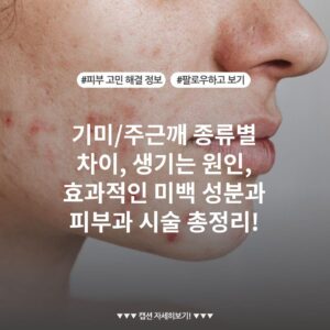 기미/주근깨 종류별 차이, 생기는 원인, 효과적인 미백 성분과 피부과 시술 총정리!