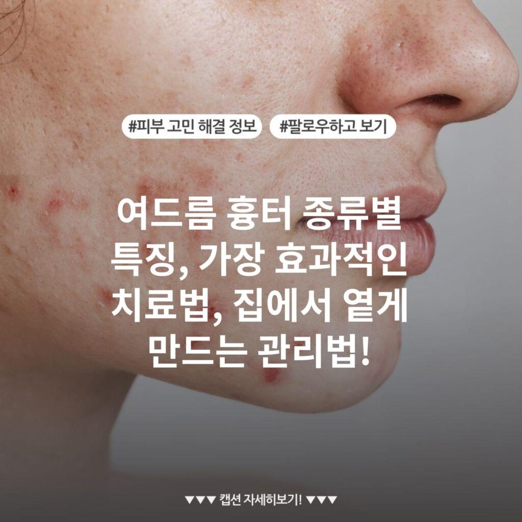 여드름 흉터 종류별 특징, 가장 효과적인 치료법, 집에서 옅게 만드는 관리법!
