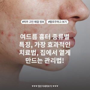 여드름 흉터 종류별 특징, 가장 효과적인 치료법, 집에서 옅게 만드는 관리법!