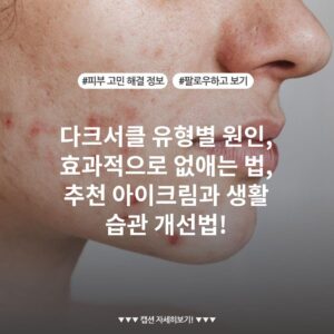 다크서클 유형별 원인, 효과적으로 없애는 법, 추천 아이크림과 생활 습관 개선법!