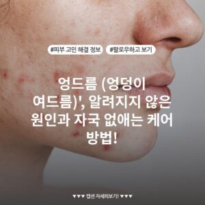 엉드름 (엉덩이 여드름)', 알려지지 않은 원인과 자국 없애는 케어 방법!
