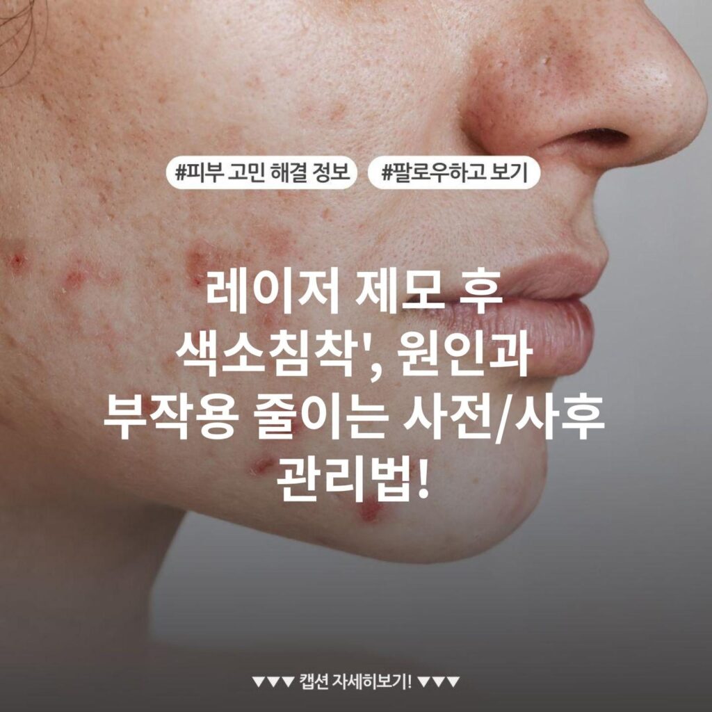 레이저 제모 후 색소침착', 원인과 부작용 줄이는 사전/사후 관리법!