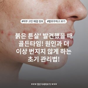붉은 튼살' 발견했을 때 골든타임! 원인과 더 이상 번지지 않게 하는 초기 관리법!