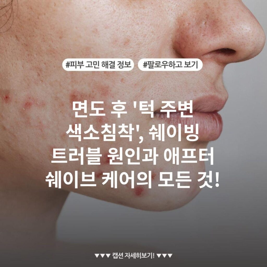 면도 후 '턱 주변 색소침착', 쉐이빙 트러블 원인과 애프터 쉐이브 케어의 모든 것!