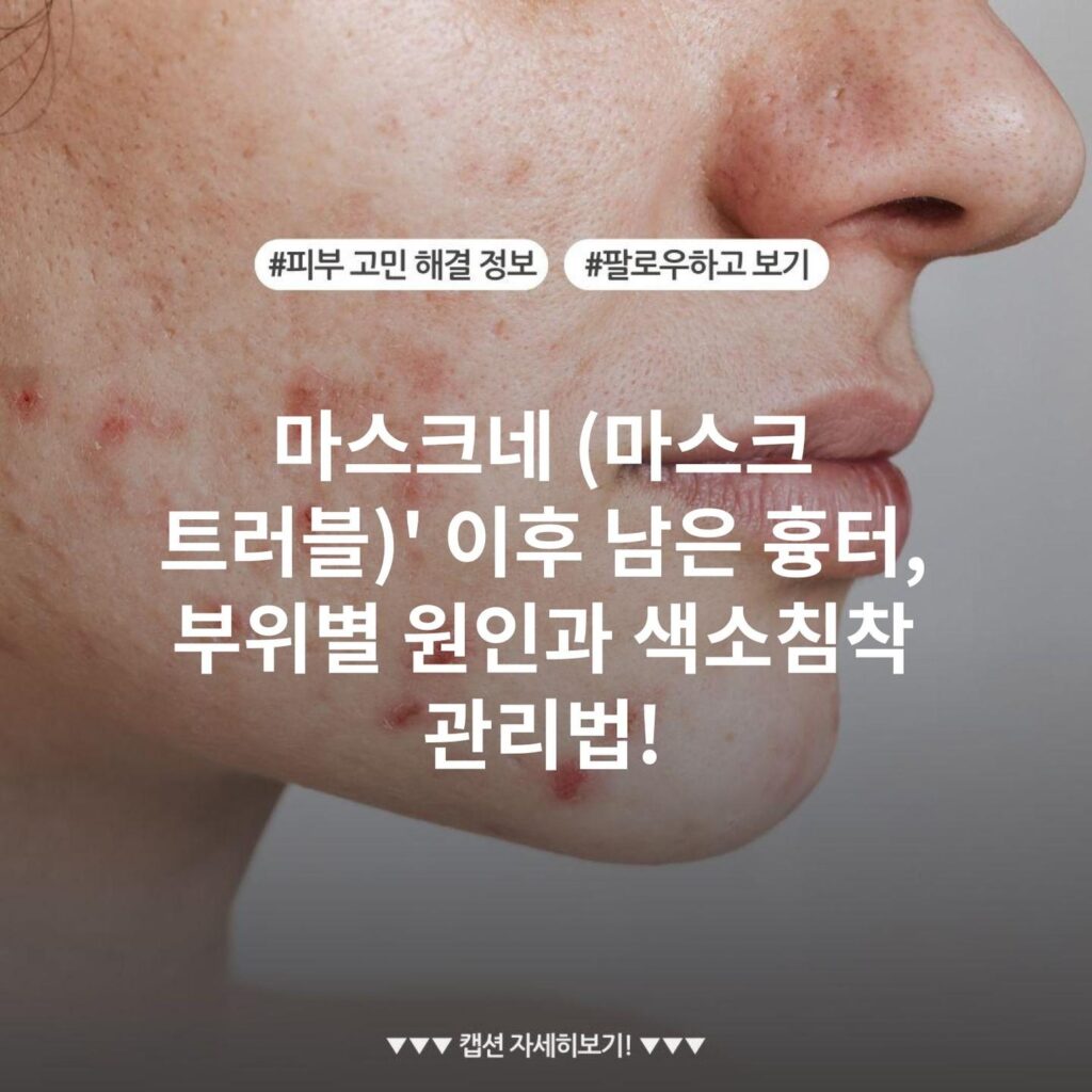 마스크네 (마스크 트러블)' 이후 남은 흉터, 부위별 원인과 색소침착 관리법!