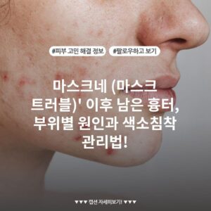 마스크네 (마스크 트러블)' 이후 남은 흉터, 부위별 원인과 색소침착 관리법!