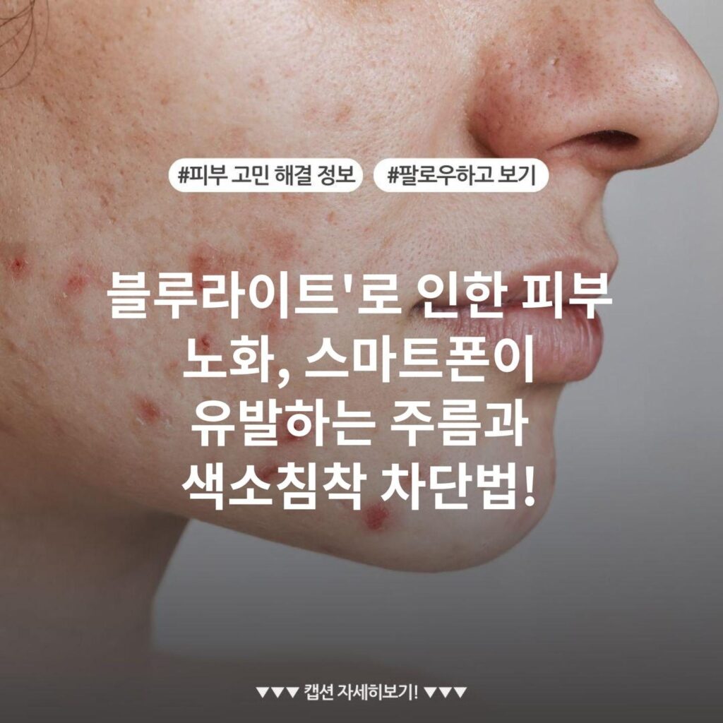 블루라이트'로 인한 피부 노화, 스마트폰이 유발하는 주름과 색소침착 차단법!