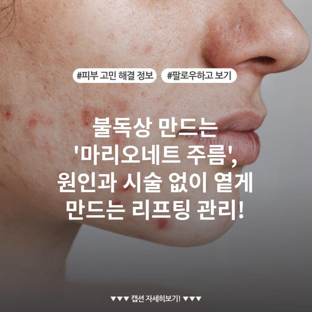 불독상 만드는 '마리오네트 주름', 원인과 시술 없이 옅게 만드는 리프팅 관리!