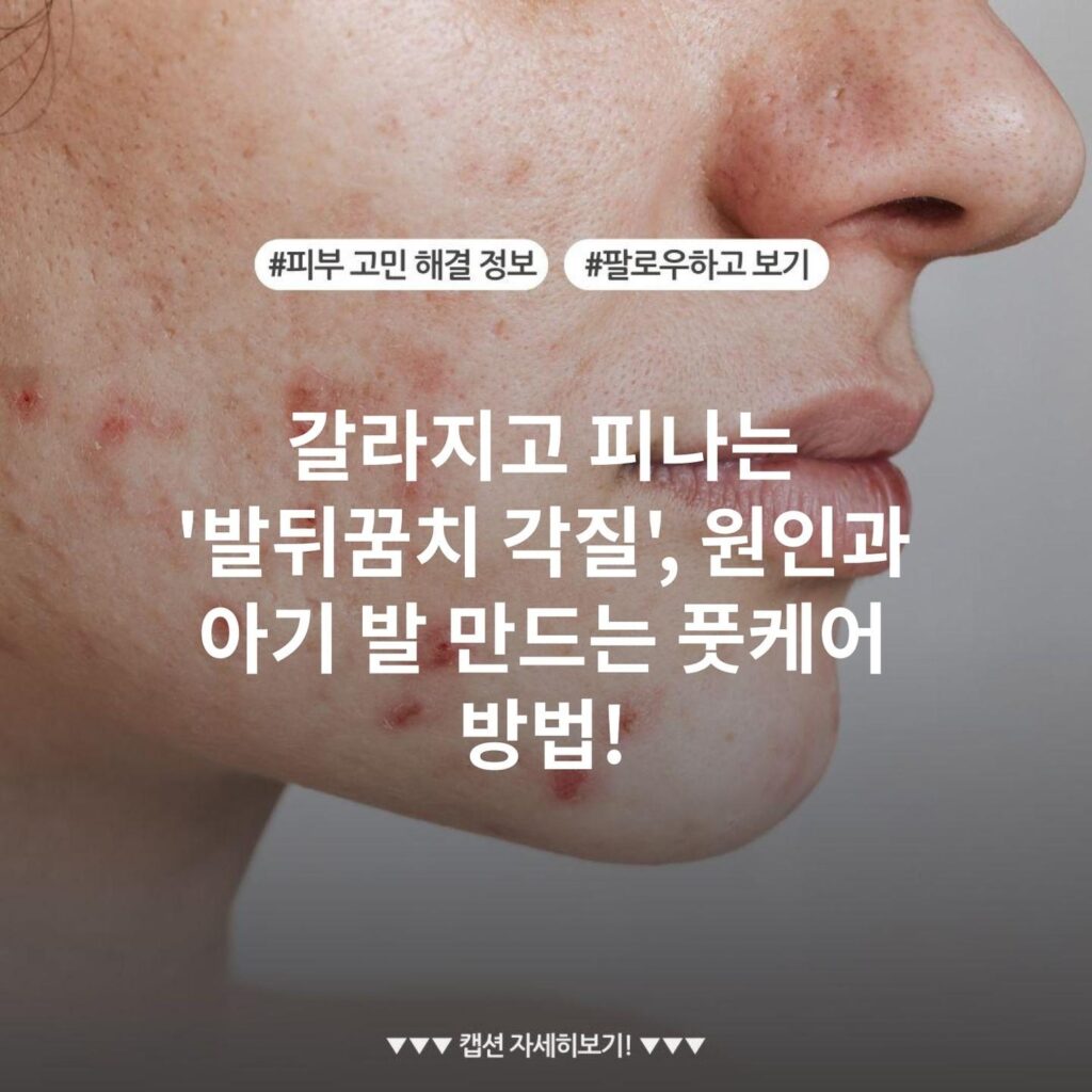 갈라지고 피나는 '발뒤꿈치 각질', 원인과 아기 발 만드는 풋케어 방법!