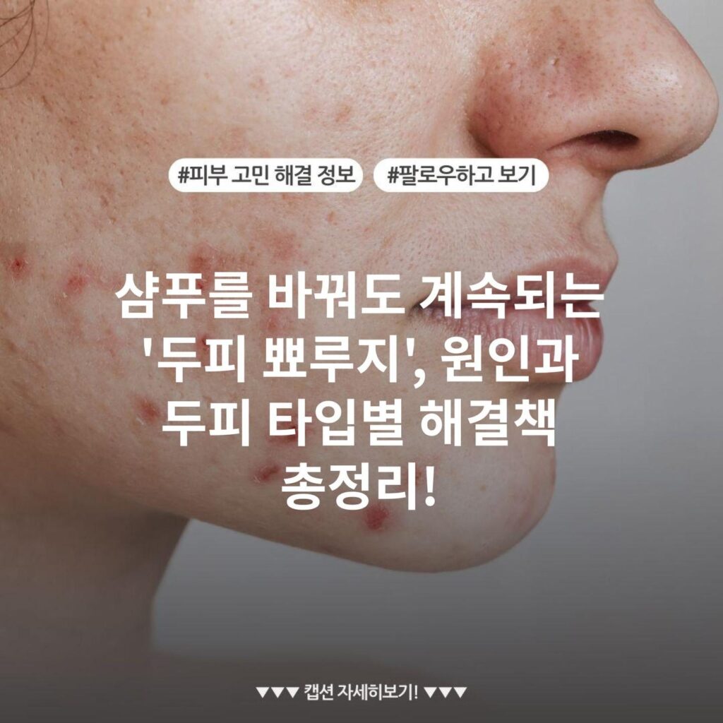 샴푸를 바꿔도 계속되는 '두피 뾰루지', 원인과 두피 타입별 해결책 총정리!