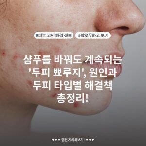 샴푸를 바꿔도 계속되는 '두피 뾰루지', 원인과 두피 타입별 해결책 총정리!